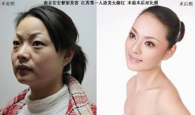 安安整形江苏第二人造美女连载之——梓菡术前感受安安